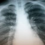 Tuberculosis: Symptoms and treatment, and who should be tested