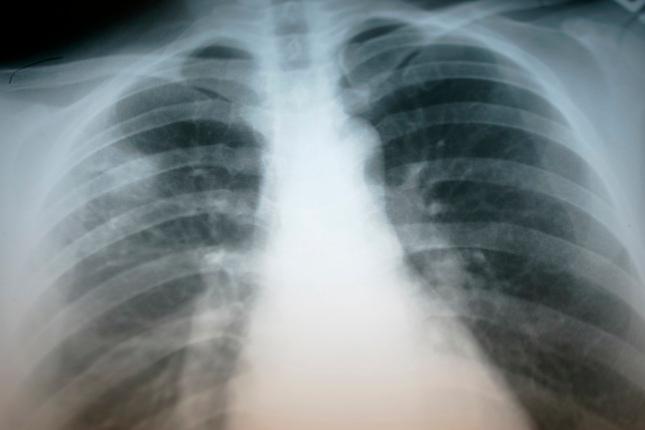 Tuberculosis: Symptoms and treatment, and who should be tested