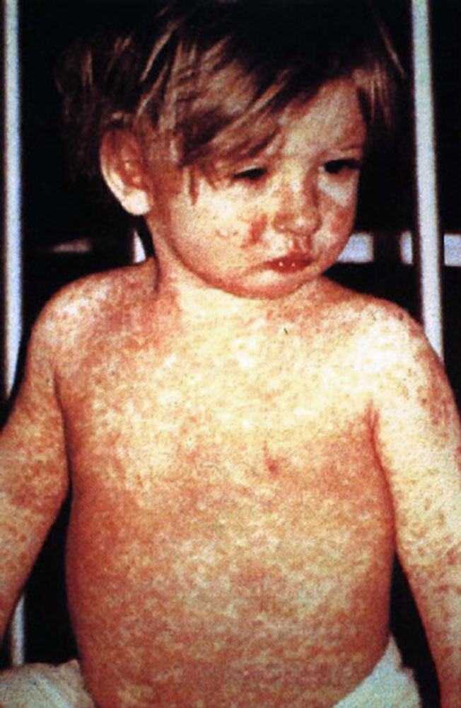 Why are measles cases popping up across the United States? Here’s what to know about the highly contagious virus