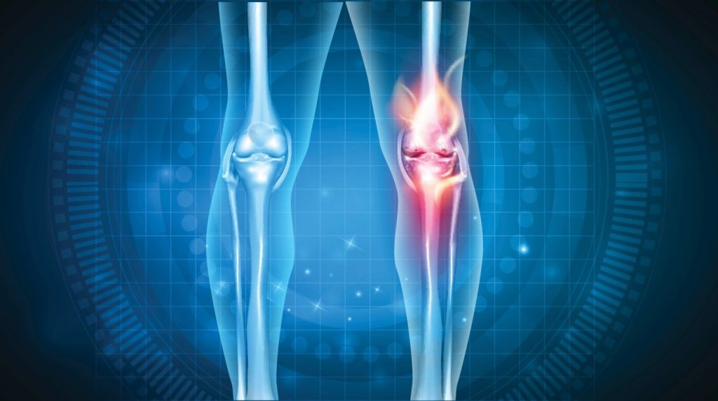 Knees stiff with arthritis? This company is studying whether fat injections can improve motion