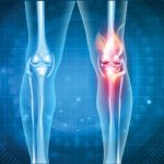 Knees stiff with arthritis? This company is studying whether fat injections can improve motion