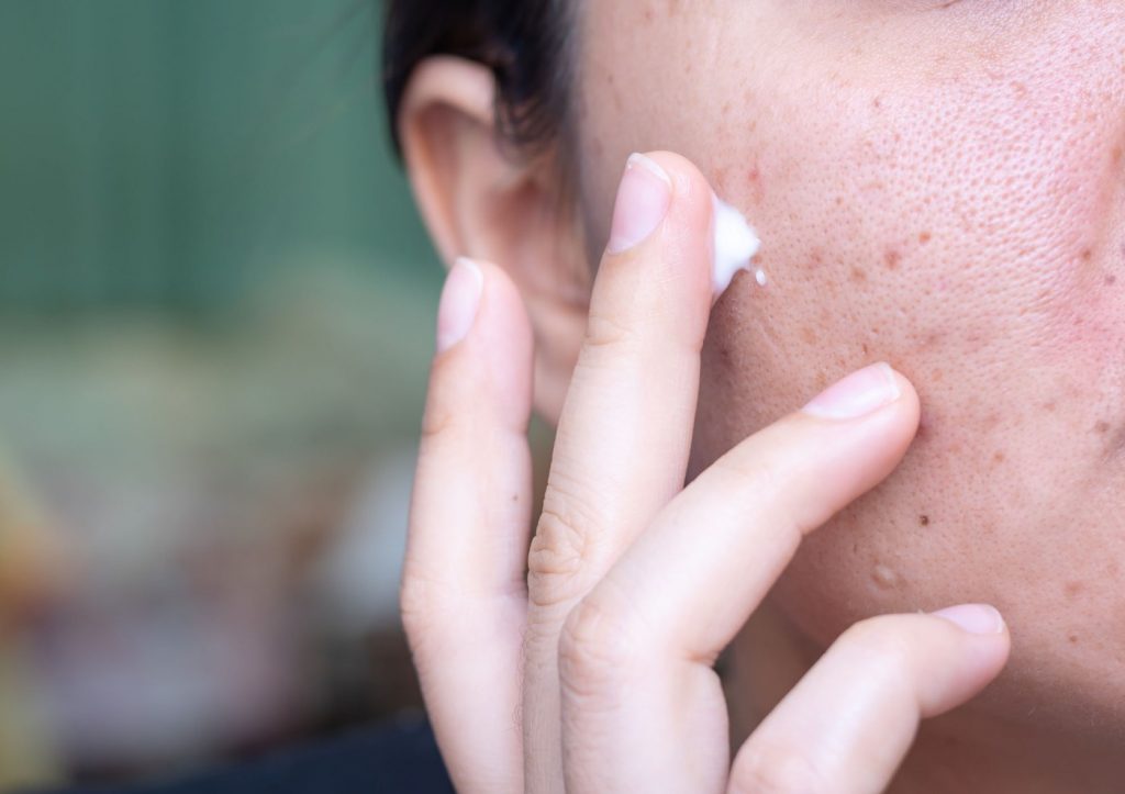 Doctors urge refrigerating acne creams to reduce cancer risk