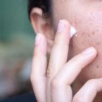 Doctors urge refrigerating acne creams to reduce cancer risk