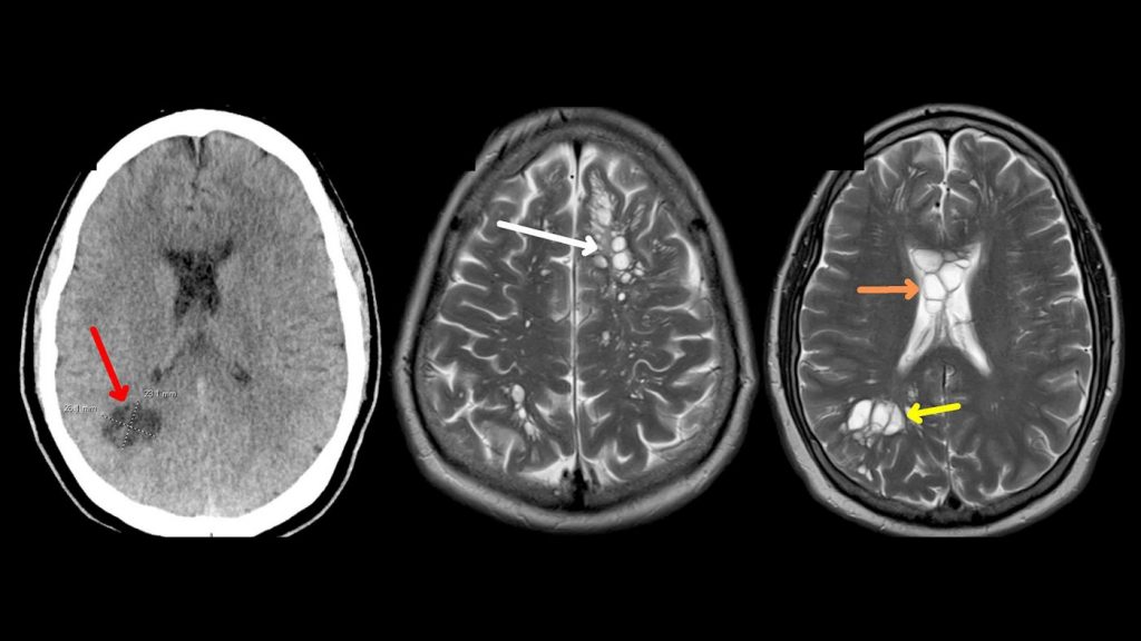 Doctors identify source of man’s migraines: tapeworm larvae, likely from undercooked bacon, in his brain