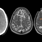 Doctors identify source of man’s migraines: tapeworm larvae, likely from undercooked bacon, in his brain