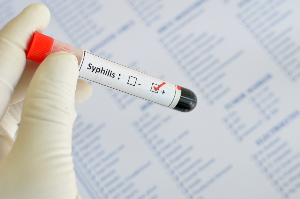 Syphilis outbreak reported in Santa Cruz County