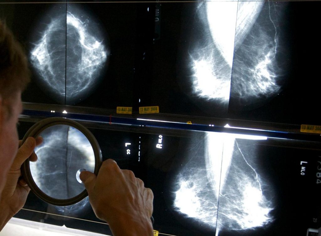 Mammograms should start at 40, panel says, as breast cancer rates rise in younger women