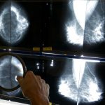 Mammograms should start at 40, panel says, as breast cancer rates rise in younger women