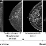 Dense breasts can make it harder to spot cancer on a mammogram